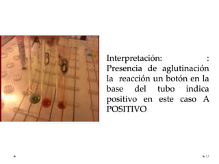 Interpretación: :
Presencia de aglutinación
la reacción un botón en la
base del tubo indica
positivo en este caso A
POSITI...
