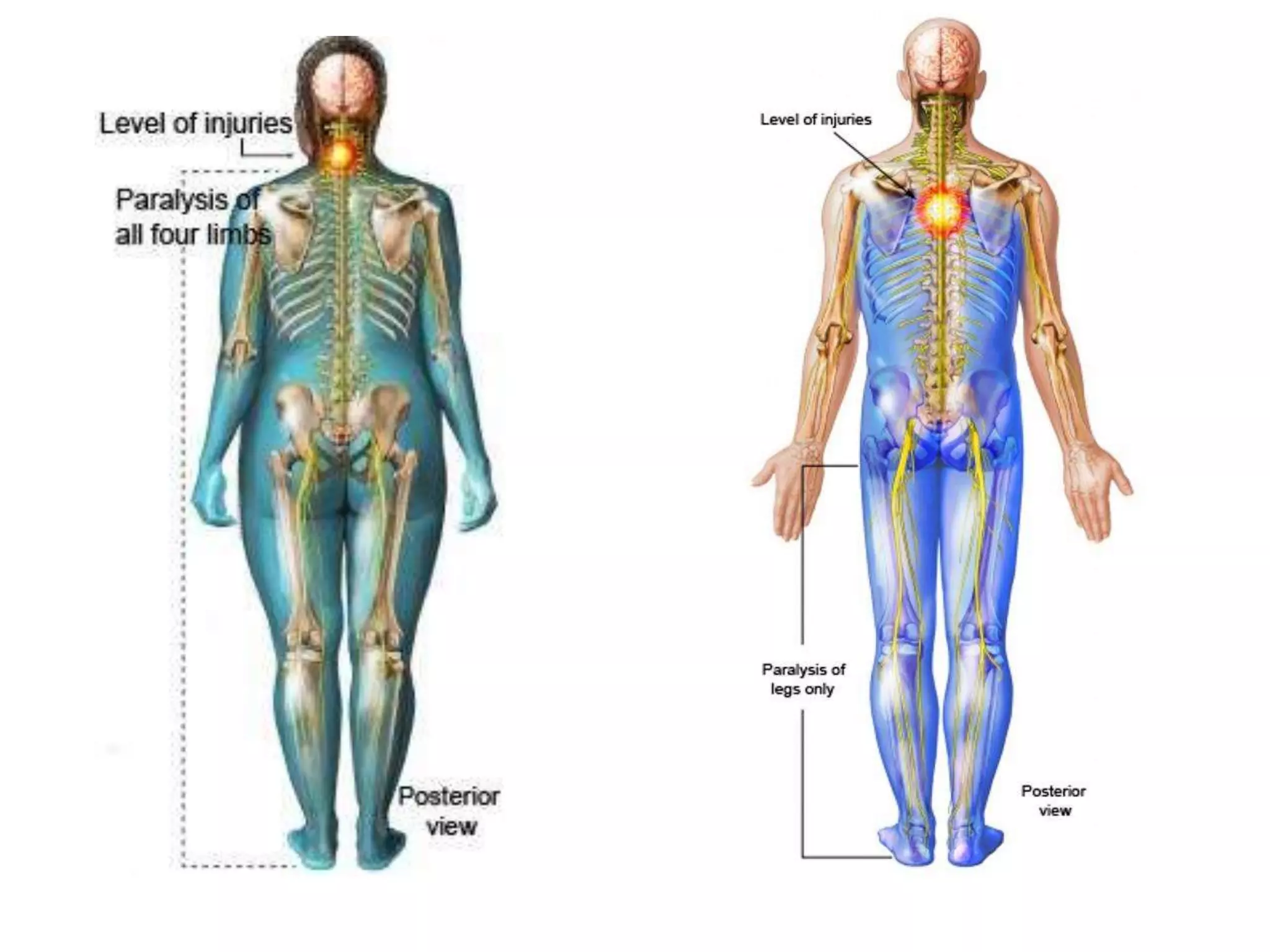Quadriplegia & Paraplegia | PPTX