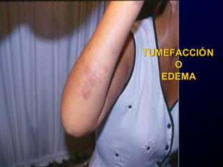 TUMEFACCIÓN
O
EDEMA
 