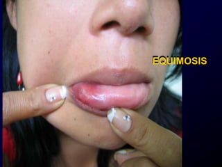 EQUIMOSIS
 