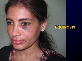 EQUIMOSIS
 