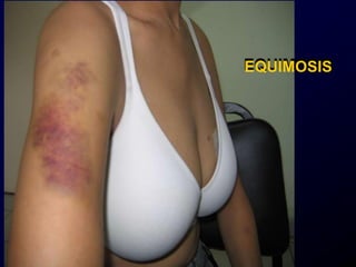EQUIMOSIS
 