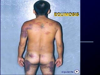 EQUIMOSIS
 