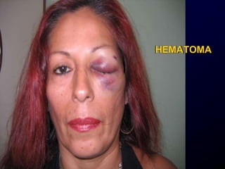HEMATOMA
 