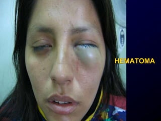 HEMATOMA
 