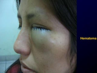Hematoma
 