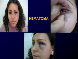 HEMATOMA
 