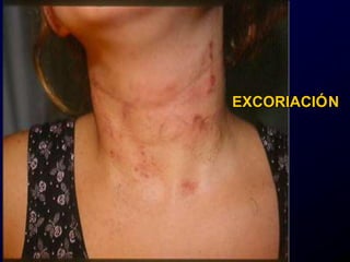 EXCORIACIÓN
 