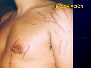 EXCORIACIÓN
 