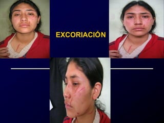 EXCORIACIÓN
 