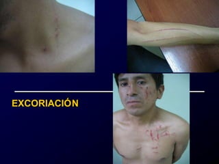 EXCORIACIÓN
 
