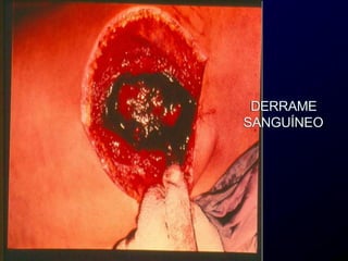 DERRAME
SANGUÍNEO
 