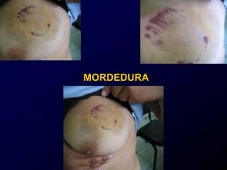 MORDEDURA
 