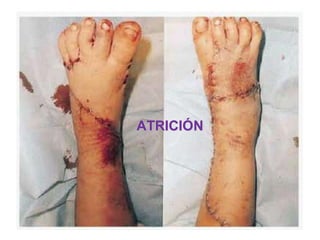 ATRICIÓN
 