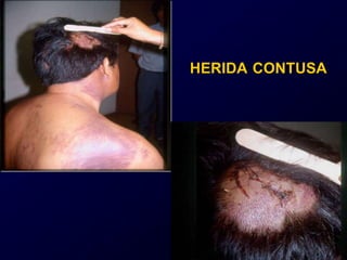 HERIDA CONTUSA
 