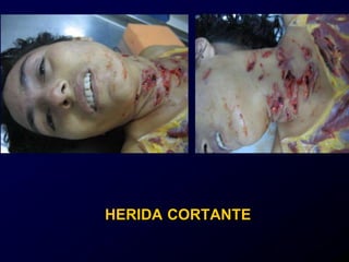 HERIDA CORTANTE
 