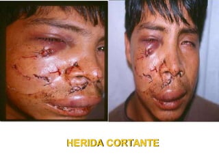 HERIDA CORTANTE
 