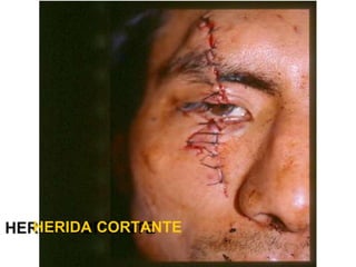 HERIDA CORTANTE
 