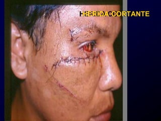 CORTANTE
HERIDA
 