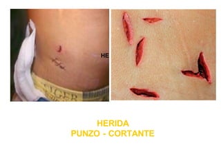 HERIDA
PUNZO - CORTANTE
 