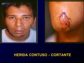 HERIDA CONTUSO - CORTANTE
 