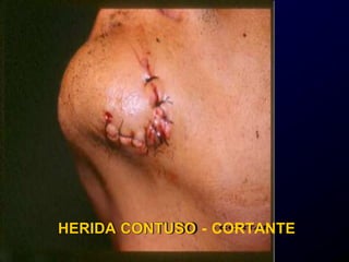HERIDA CONTUSO - CORTANTE
 