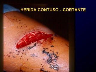 HERIDA CONTUSO - CORTANTE
 