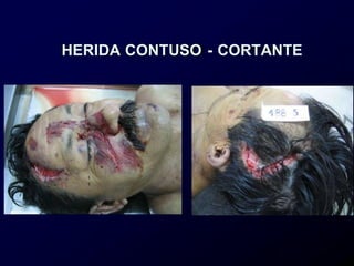 HERIDA CONTUSO - CORTANTE
 