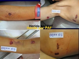 Herida por PAF
 