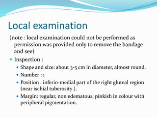 Local examination
(note : local examination could not be performed as
permission was provided only to remove the bandage
and see)
 Inspection :
 Shape and size: about 3-5 cm in diameter, almost round.
 Number : 1
 Position : inferio-medial part of the right gluteal region
(near ischial tuberosity ).
 Margin: regular, non edematous, pinkish in colour with
peripheral pigmentation.
 