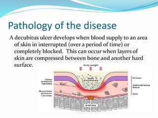 Pathology of the disease
A decubitus ulcer develops when blood supply to an area
of skin in interrupted (over a period of time) or
completely blocked. This can occur when layers of
skin are compressed between bone and another hard
surface.
 