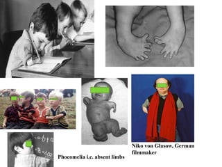 Niko von Glasow, German
filmmaker
Phocomelia i.e. absent limbs
 