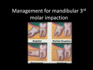 Management for mandibular 3rd molar impaction 