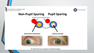 3rd nerve palsy by maj shafiqua.pptxhkhj | PPTX