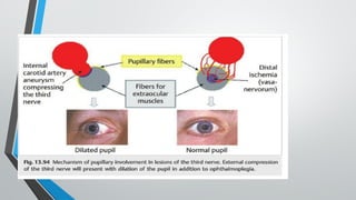 3rd nerve palsy by maj shafiqua.pptxhkhj | PPTX