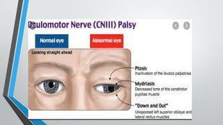 3rd nerve palsy by maj shafiqua.pptxhkhj | PPTX