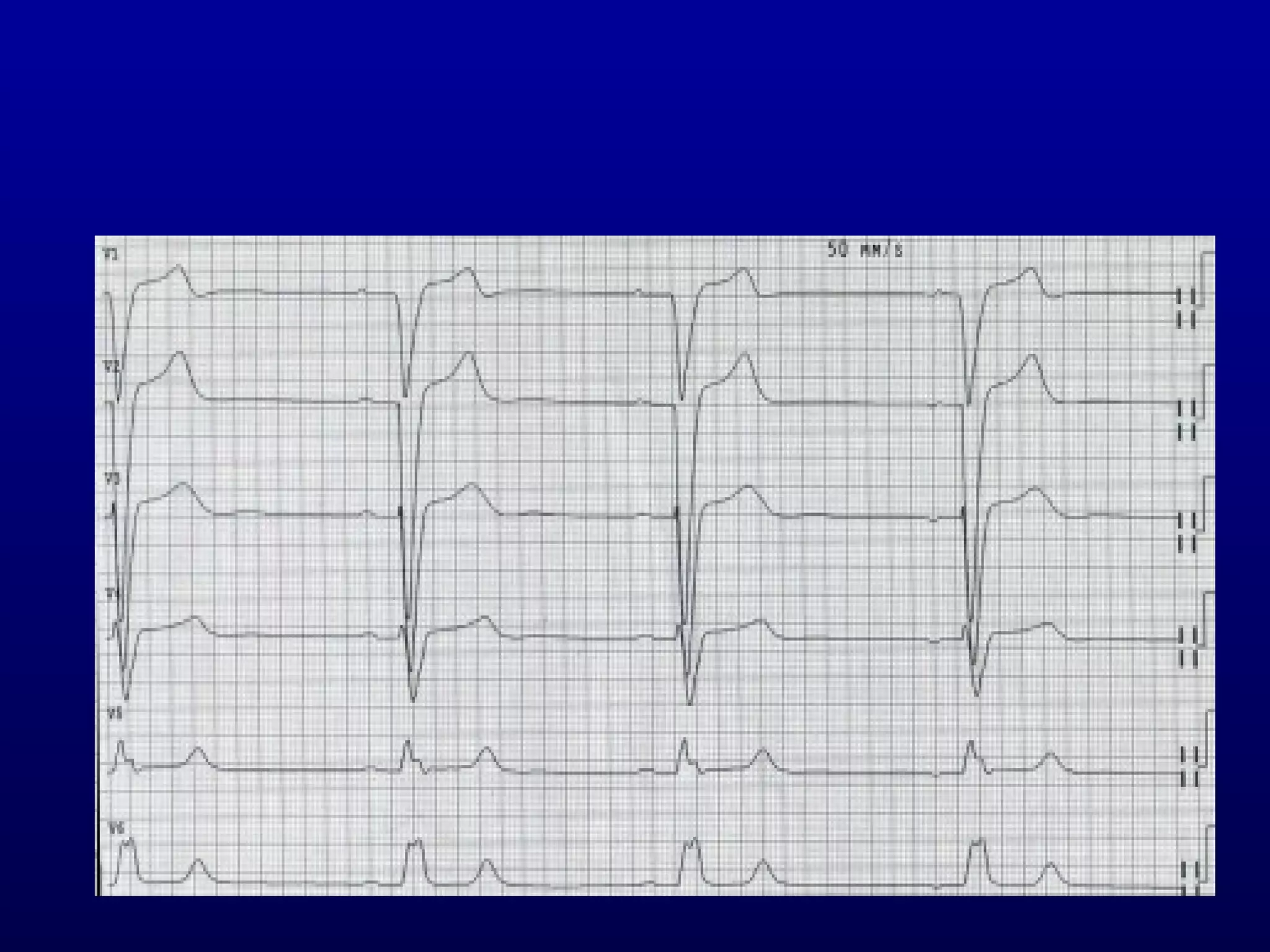 3rd part ECG Basics QRS complex Dr Salah Mabrouk Khallaf | PPT