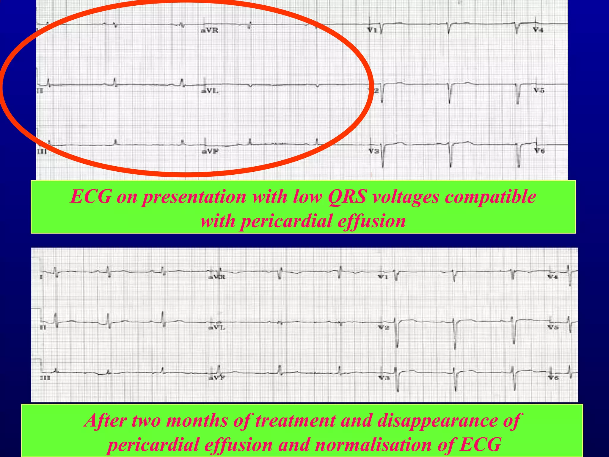 3rd part ECG Basics QRS complex Dr Salah Mabrouk Khallaf | PPT