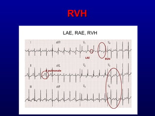 3rd part ECG Basics QRS complex Dr Salah Mabrouk Khallaf | PPT