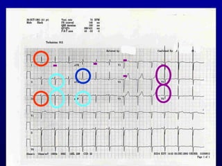 3rd part ECG Basics QRS complex Dr Salah Mabrouk Khallaf | PPT