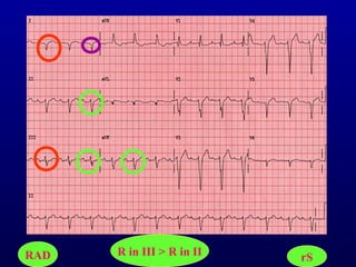 3rd part ECG Basics QRS complex Dr Salah Mabrouk Khallaf | PPT