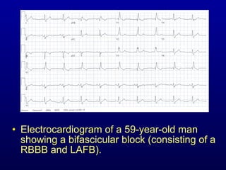 3rd part ECG Basics QRS complex Dr Salah Mabrouk Khallaf | PPT