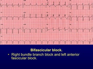 3rd part ECG Basics QRS complex Dr Salah Mabrouk Khallaf | PPT