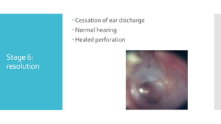 Stage 6:
resolution
 Cessation of ear discharge
 Normal hearing
 Healed perforation
 