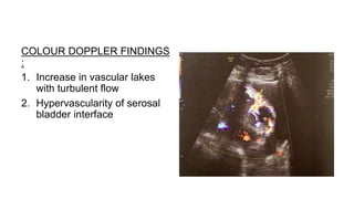 COLOUR DOPPLER FINDINGS
:
1. Increase in vascular lakes
with turbulent flow
2. Hypervascularity of serosal
bladder interface
 
