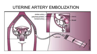 UTERINE ARTERY EMBOLIZATION
 