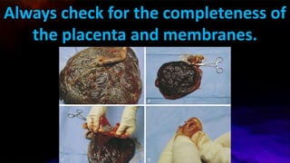 Always check for the completeness of
the placenta and membranes.
 