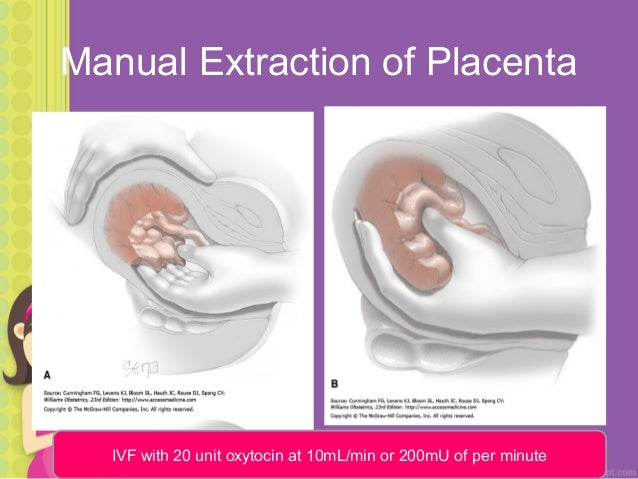 3rd Stage Of Labor Abnormalities By Liza Tarca Md