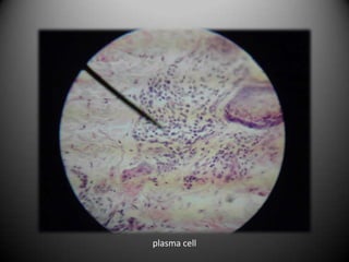 plasma cell
 