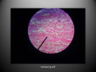 tumour g cell
 